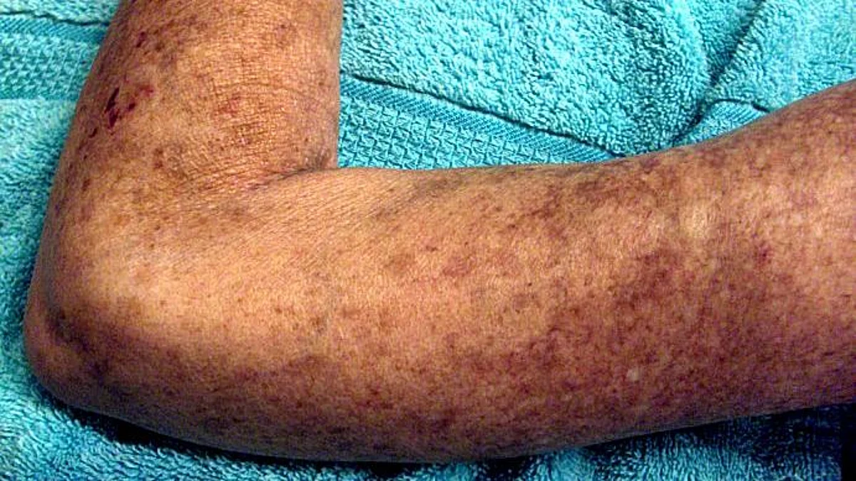 Systemic sclerosis — or scleroderma that affects the skin and internal organs -, is one of the rarest autoimmune diseases, affecting roughly 100,000 people (primarily women) in the United States (Wikimedia Commons)