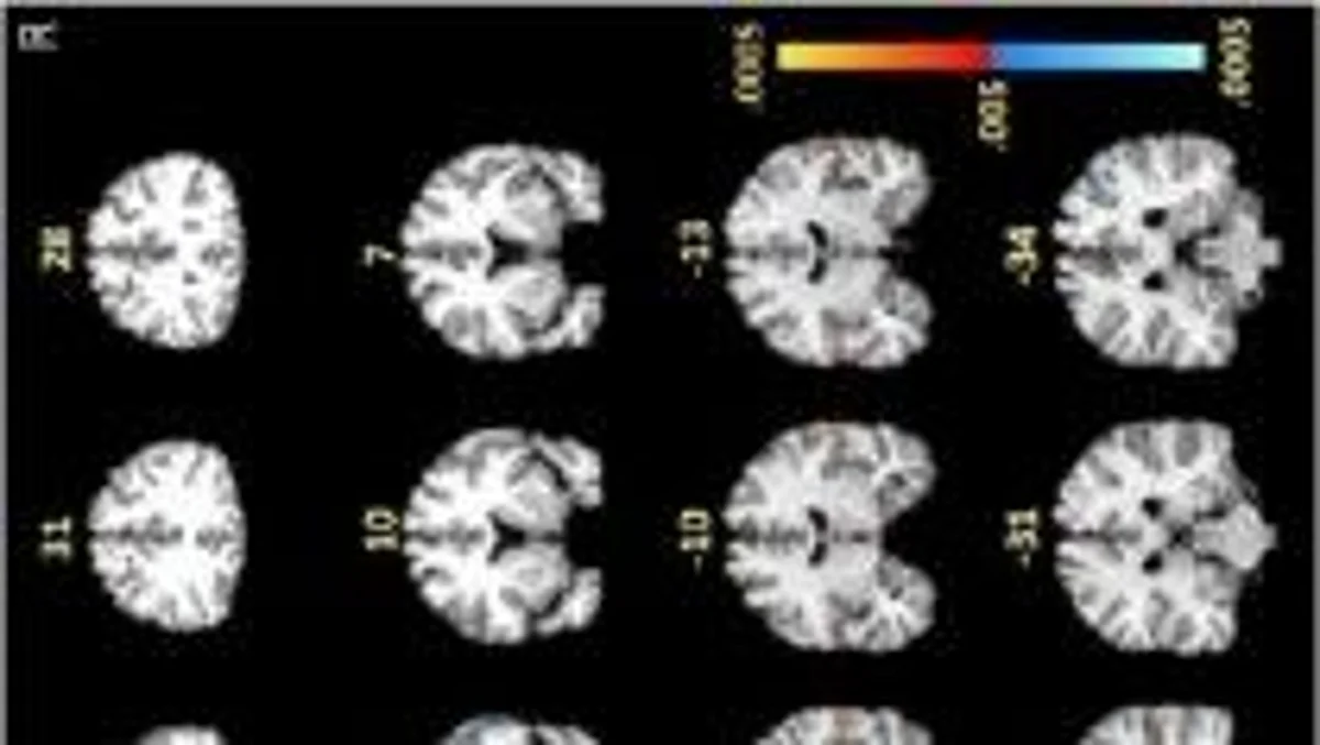 Noted by arrows, and yellow and red coloring, these brain scans indicate high activation levels of white matter in the frontal lobes of participants with post-treatment Lyme disease while performing a memory task. Participants without post-treatment Lyme did not show the same white matter activations.
