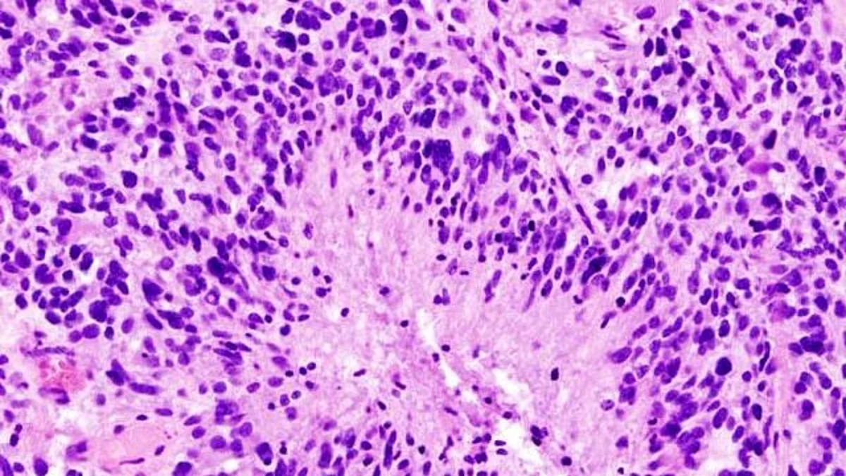 Glioblastoma is a lethal cancer that is always considered as an aggressive, stage 4 tumor at diagnosis with patients living an average of 15 months after diagnosis.