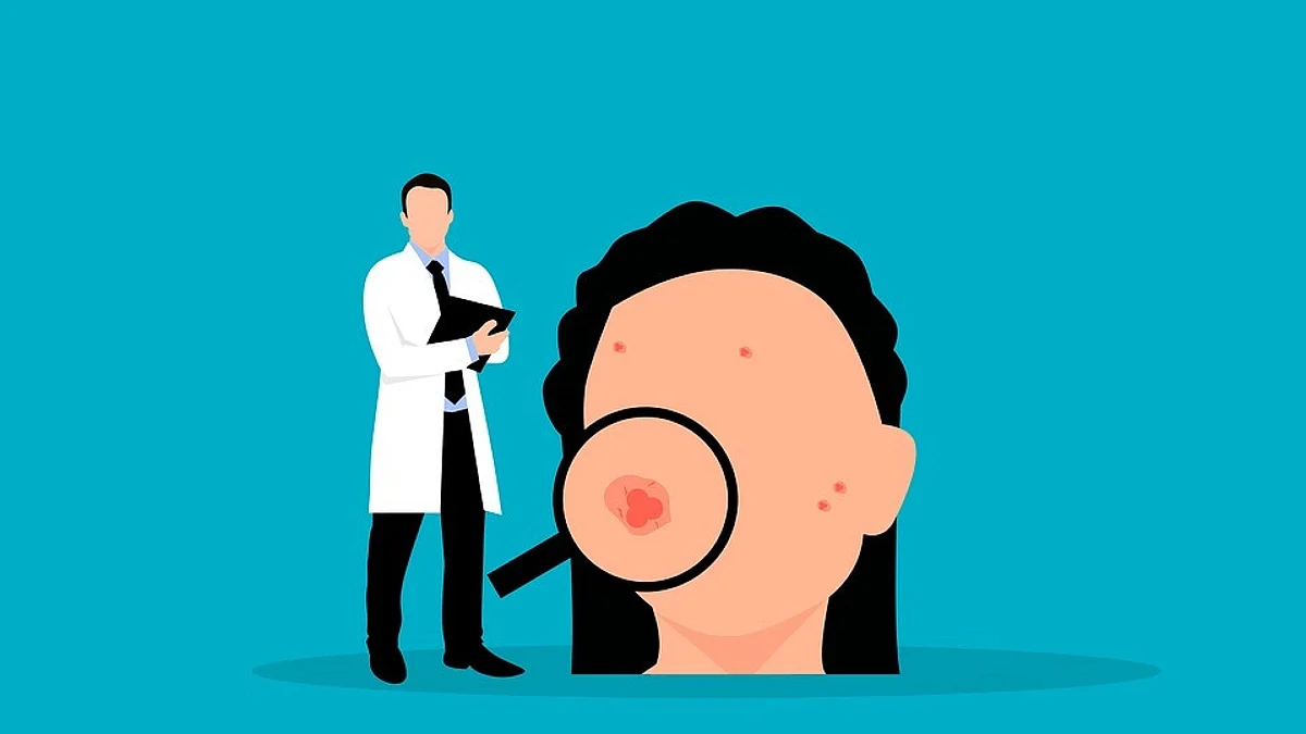 Does acne also affect adults?(Pixabay)
