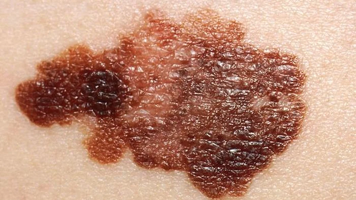 A new way of reprogramming our immune cells to shrink or kill off cancer cells has been shown to work in the otherwise hard to treat and devastating skin cancer, melanoma.
