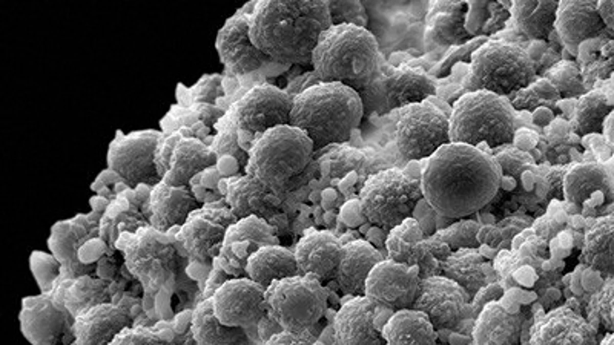 A scanning electron micrograph depicts a clump of prostate cancer cells (Newswise)