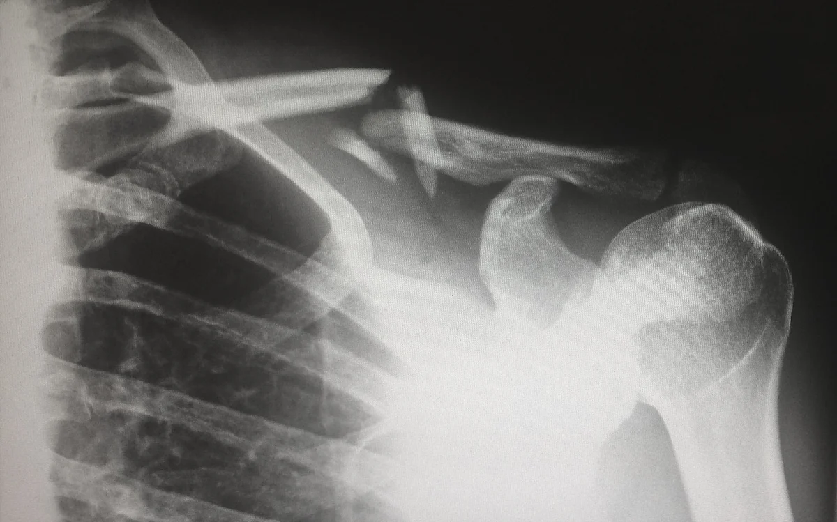 The shoulder service at UTSW performs some of the highest volumes of primary and revision shoulder arthroplasty in the country. (Image: Unsplash)