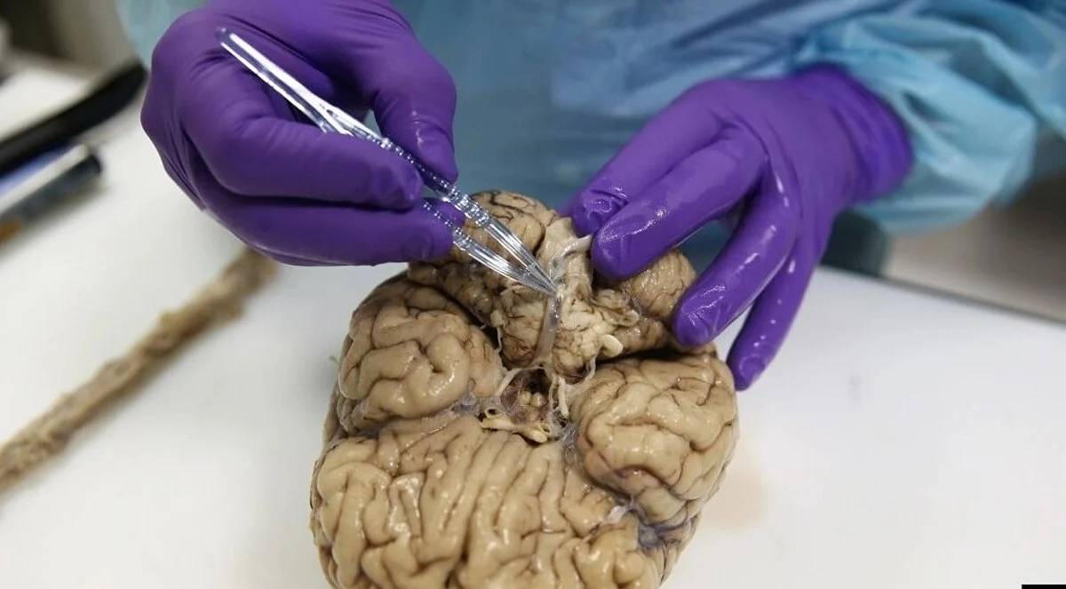 Parkinson disease is a progressive neurodegenerative disorder caused by accumulation of a-synuclein (aS) in the enteric (ENS) and central nervous system (CNS). In addition to motor symptoms, persons with Parkinson disease may experience constipation, disturbances in sleep architecture, cognitive dysfunction, psychosis, and depression, all of which result from impaired function of neural pathways not restored by replacement of dopamine.
