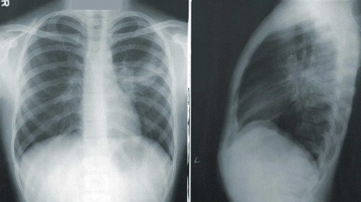 lung cancer have identified a new potential treatment, which could also aid early detection of the disease. (Image: Unsplash)
