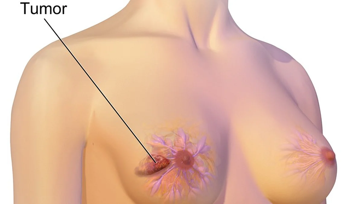 Depiction of Breast Cancer. (Image: Wikimedia Commons)