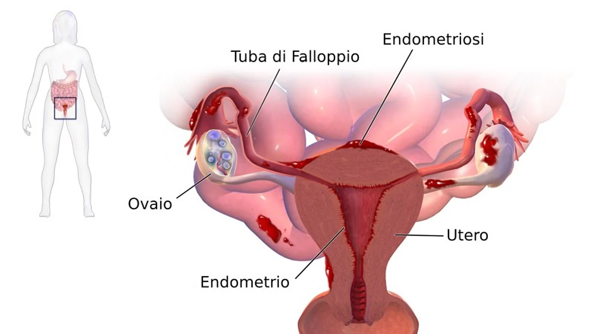 Depiction of Endometriosis. Wikipedia Commons