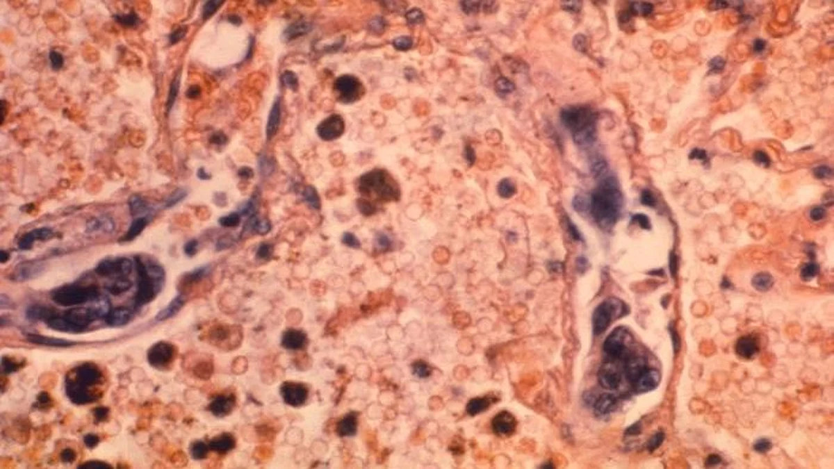 New research findings show how higher viscosity, or resistance to flow, of the extracellular fluid that surrounds cells enables cancer cells to migrate more rapidly from a primary tumor to other sites in the body.
