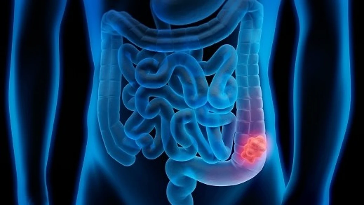 High levels of ammonia in tumors leads to fewer T cells and immunotherapy resistance in mouse models of colorectal cancer (Unsplash)