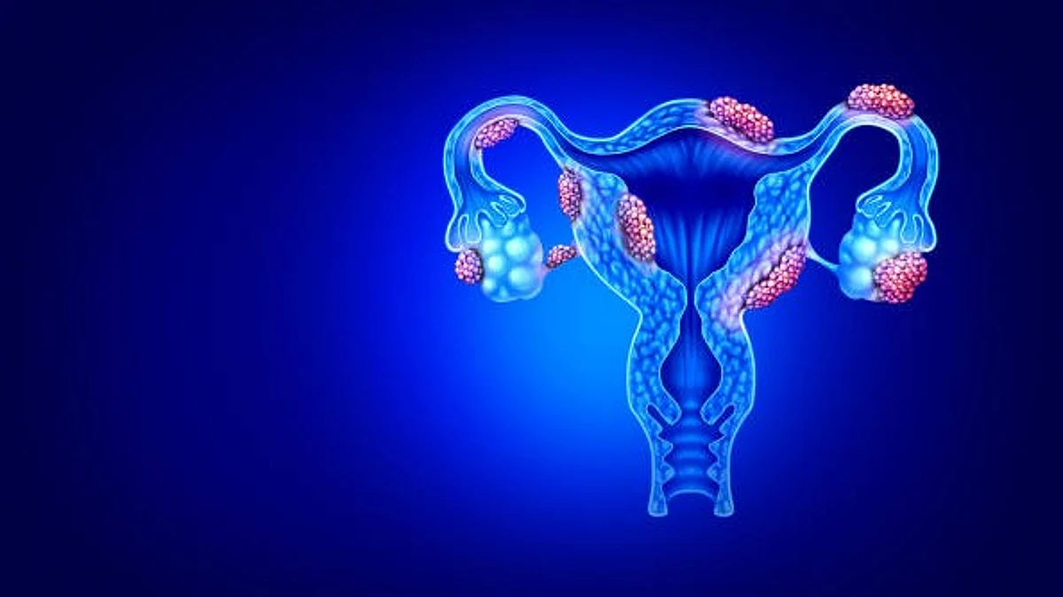 Fibroids can, in rare instances, make it difficult for a woman to become pregnant or carry a child to term. They may make pregnancy more difficult and, in the worst cases, result in infertility