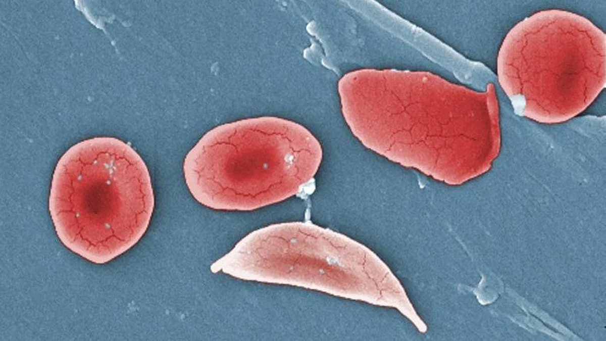 Sickle cell disease affects an estimated 100,000 people in the U.S., and the vast majority of them are Black. Federal and charitable dollars dedicated to fighting sickle cell disease pale in comparison to what is spent to combat other, less common diseases that mostly affect white patients.