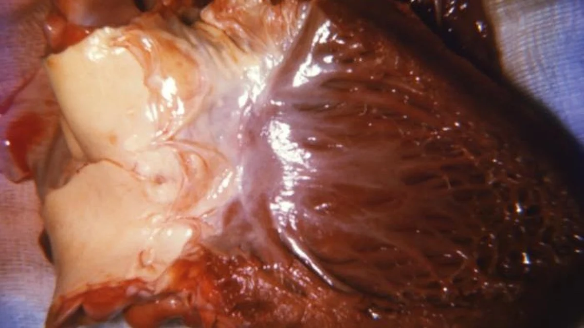 The University of Chicago Medicine transplant team performed the health system’s first donated-after-circulatory death (DCD) heart transplant on Nov. 19, 2022.