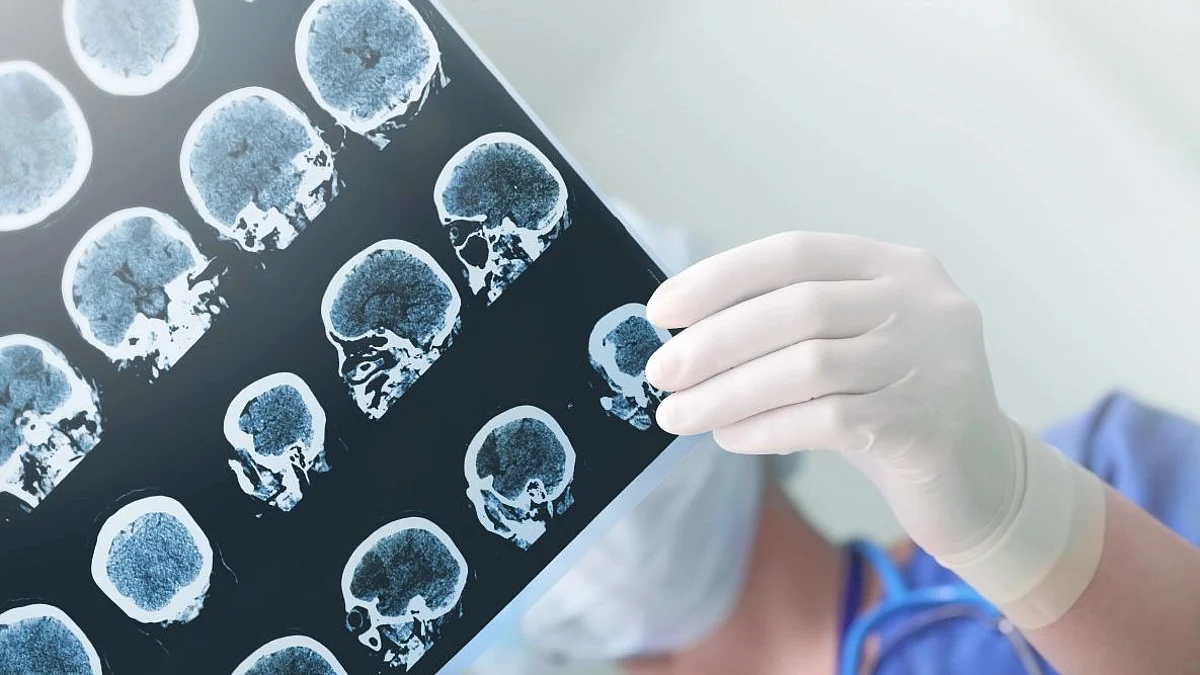 Following a modified Atkins diet high in fat and low in carbohydrates plus taking medication may reduce seizures in people with tough-to-treat epilepsy.