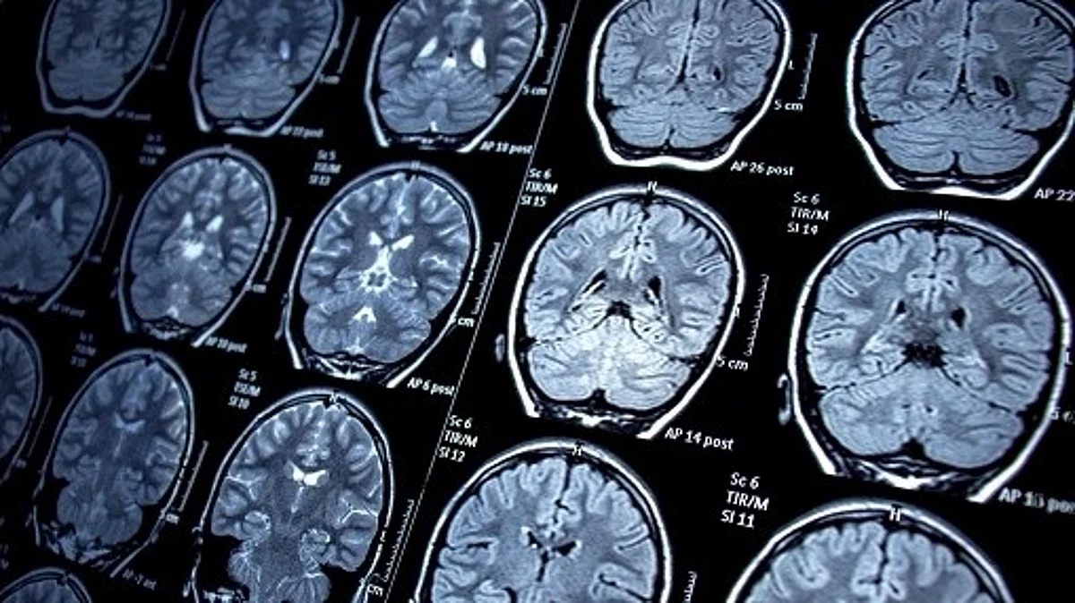 Absence seizures can be captured by abnormal rhythms on EEG recordings, but their neuronal cause has never before been identified.