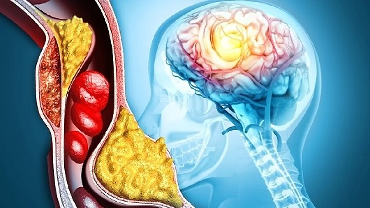 Brain stroke - hemorrhagic and ischemic problem. Arteriosclerosis, infarct, ischemia, thrombosis disease. (Unsplash)