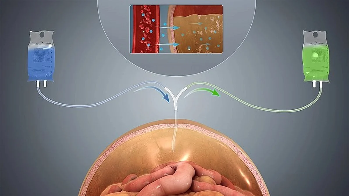 Peritoneal dialysis in case of kidney failure. Wikimedia Commons