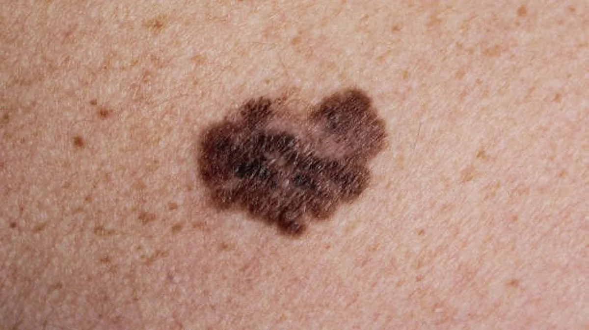 Fewer cases of melanoma were observed among regular users of vitamin D supplements than among non-users, a new study finds. People taking vitamin D supplements regularly also had a considerably lower risk of skin cancer, according to estimates by experienced dermatologists.