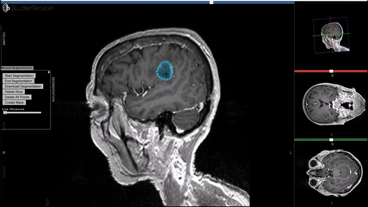 MRI of Brain Tumor. Wikimedia Commons
