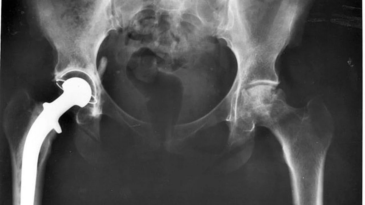 Technique can suppress infections and encourage healing around prosthetics without the problems caused by antibiotics and tissue grafting. (WIKIMEDIACOMMONS)