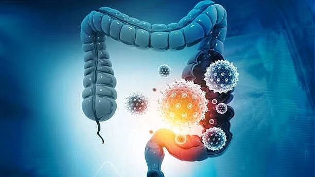 Unhealthy Gut Sets Stage For Breast Cancer To Spread