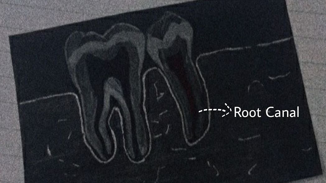 Getting to the ROOT of your Root Canal Treatment