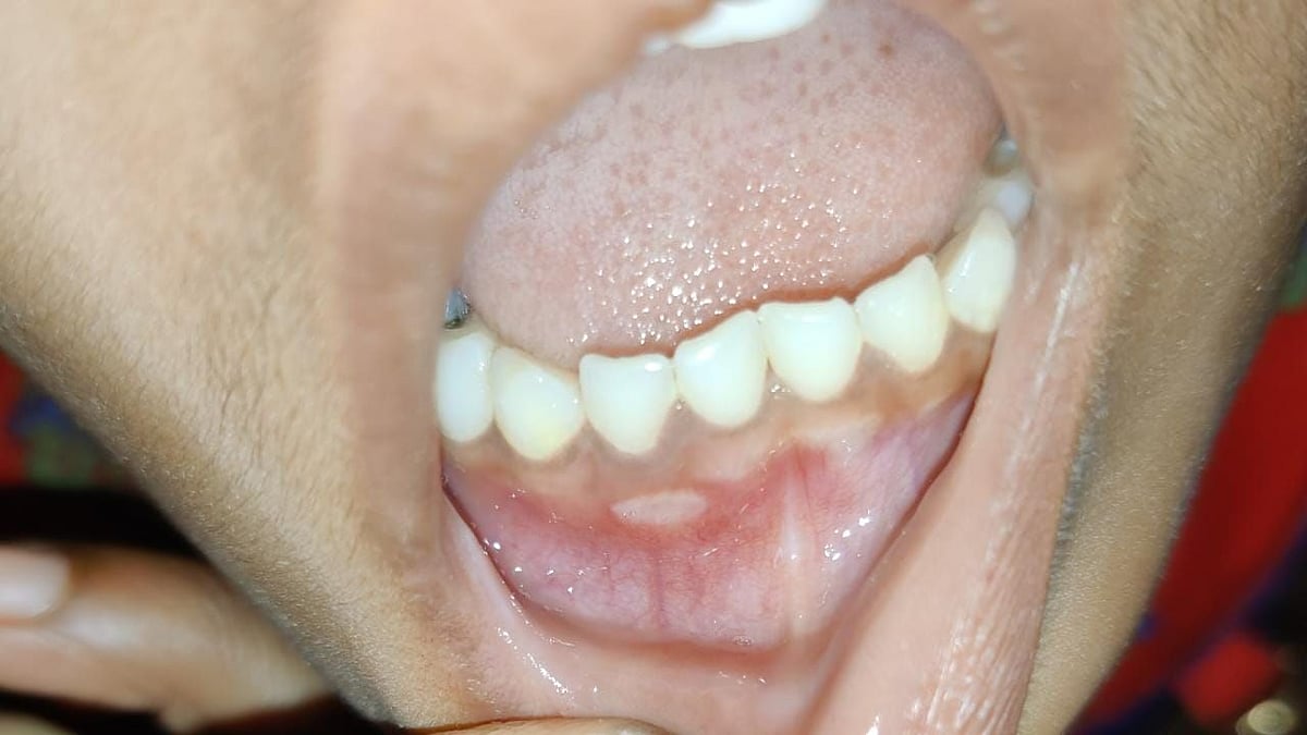 Traumatic Oral lesions Symptoms and Prevention Methods.