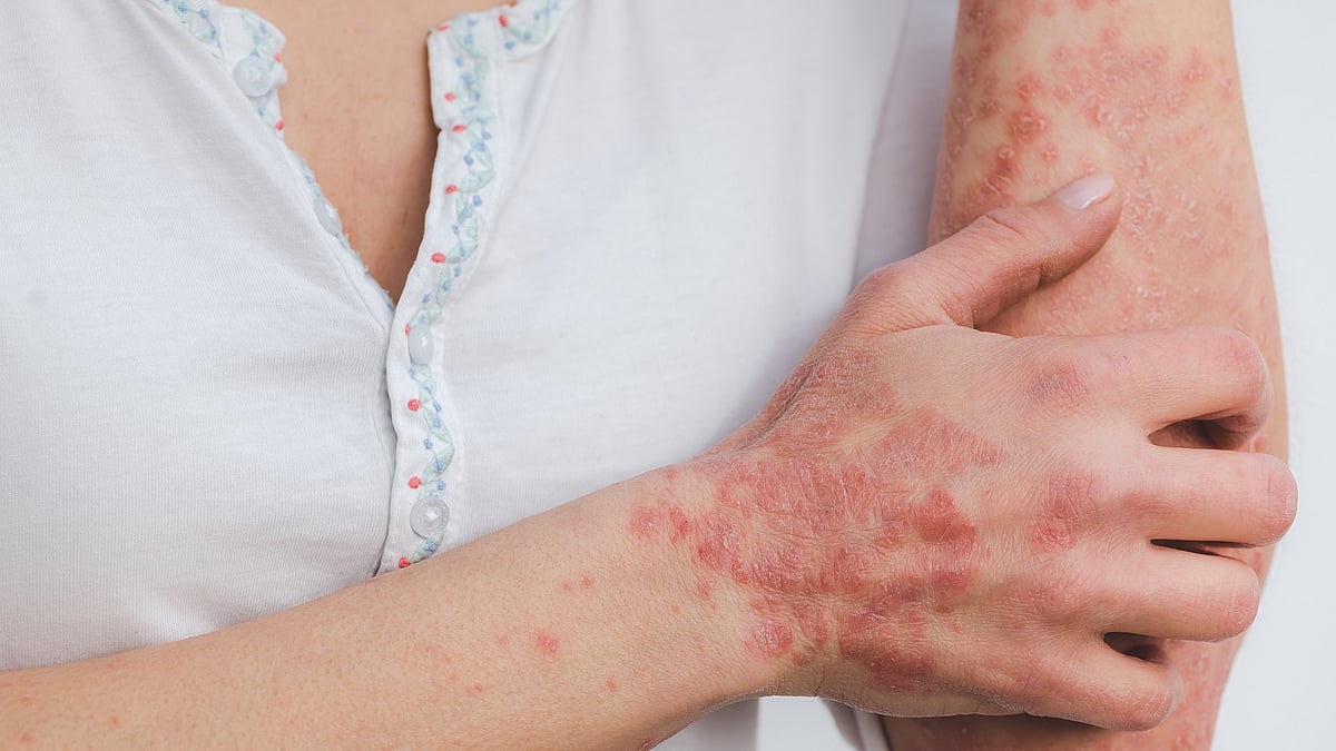What is Contact dermatitis?