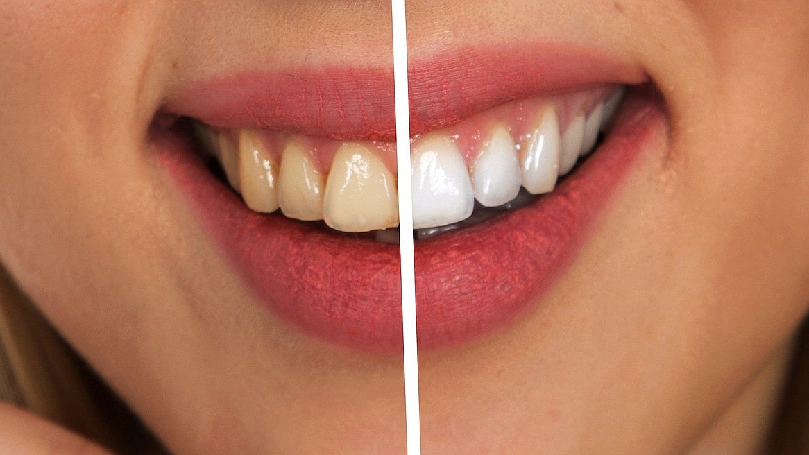 50 Shades of Teeth Discoloration What Is Tooth Discoloration And