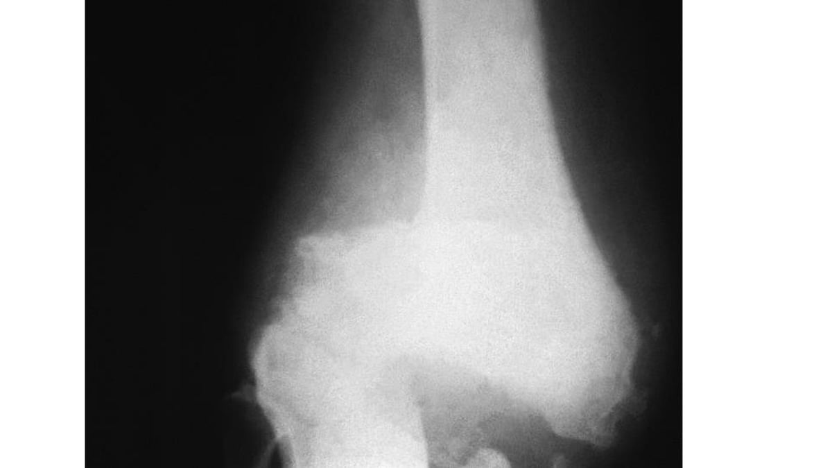 Role of Manual Therapy in Osteoarthritis of the Knee Joint