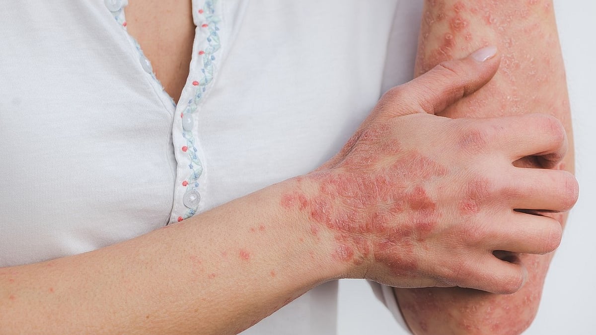 How to tell the difference between Eczema and Psoriasis
