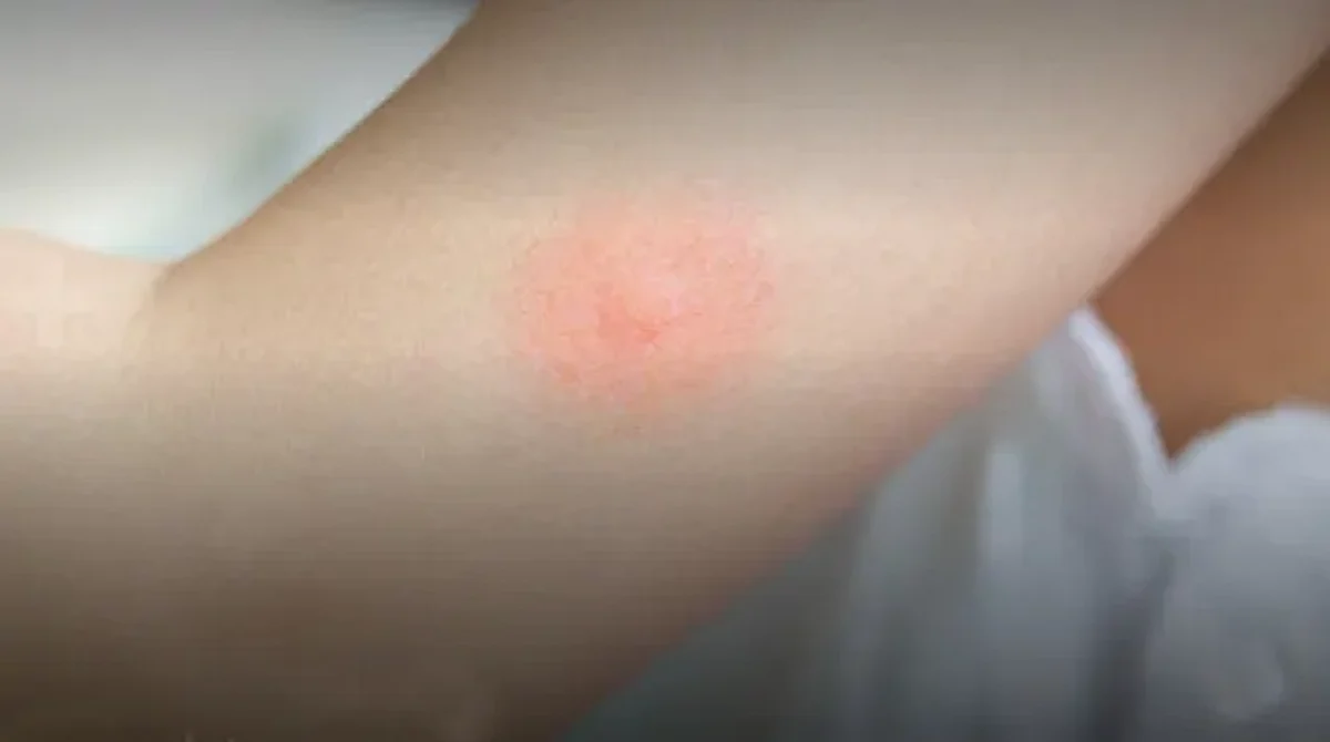 Michoacán acumuló mil 100 probables a dengue; 123, positivos
