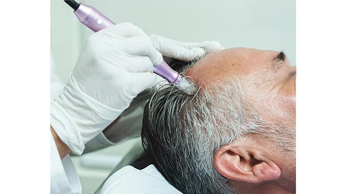 CIENCIA: Detectan mecanismo genético que podría detener y prevenir la calvicie