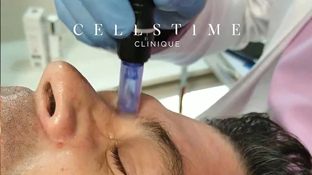 ¡Olvídese de las cirugías! Con células madre puede conseguir rejuvenecimiento facial