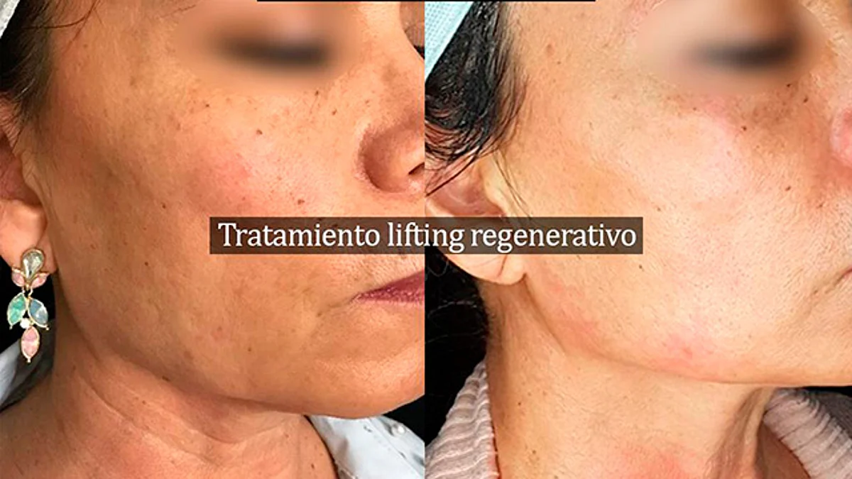 ¿Vienes de EUA? Aprovecha a un super precio tratamientos de belleza con células madre
