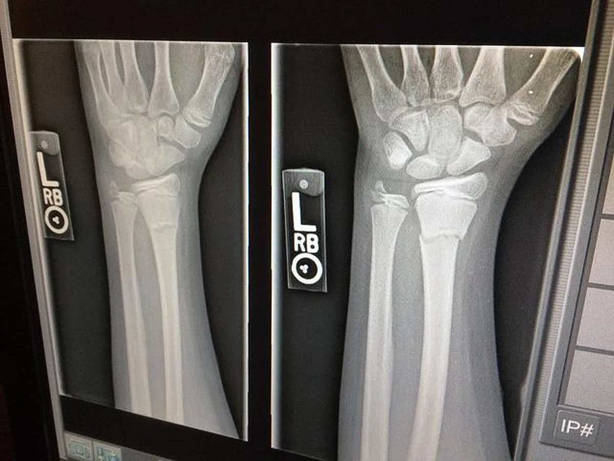 Personas que padecen osteoporosis no deberían tener miedo de hacer ejercicio con regularidad