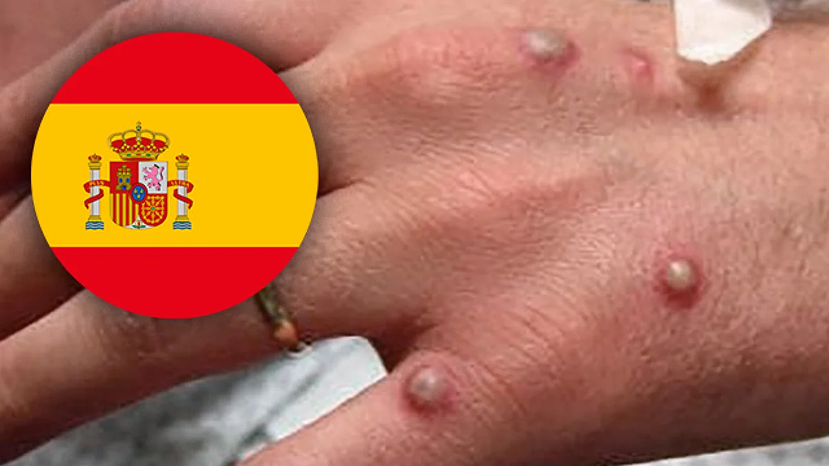 Segunda muerte por viruela del mono en España en menos de 24 horas