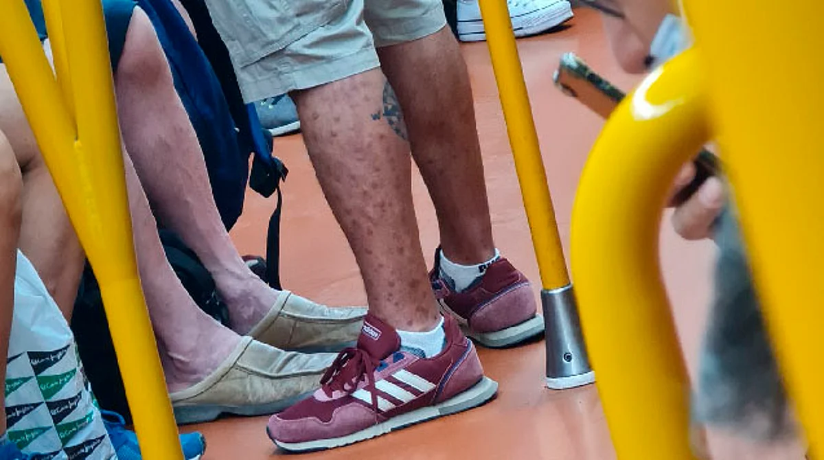 Hombre con viruela del mono se sube al metro y médico lo denuncia