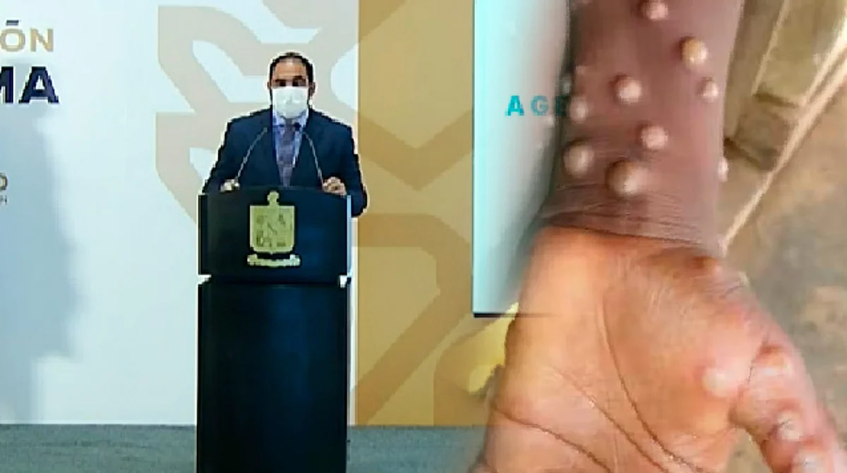 Confirman primer caso de viruela del mono en Nuevo León