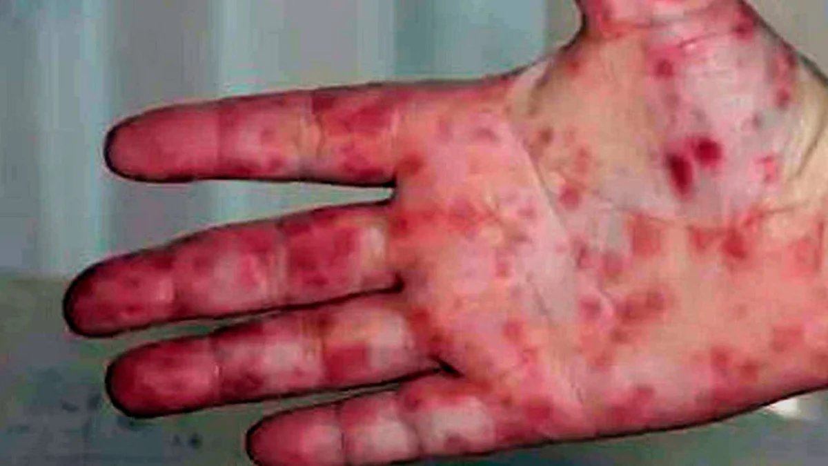 Gripe del tomate, nuevo virus que está afectando a niñas y niños en India