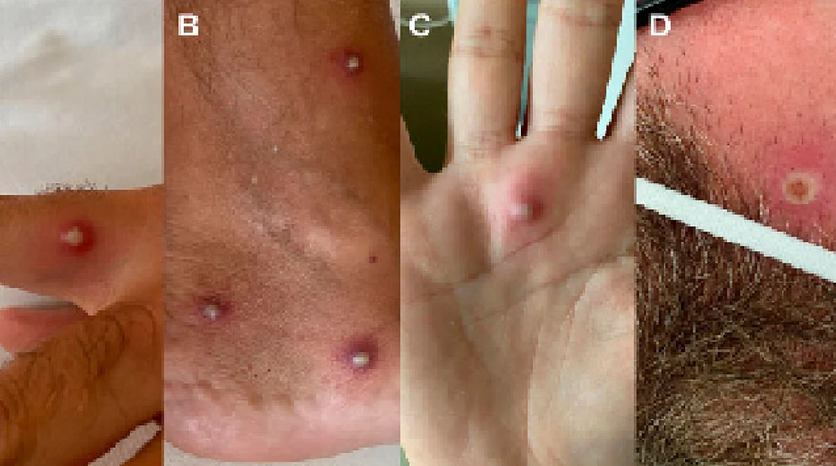 Hombre da positivo a viruela del mono, covid-19 y VIH