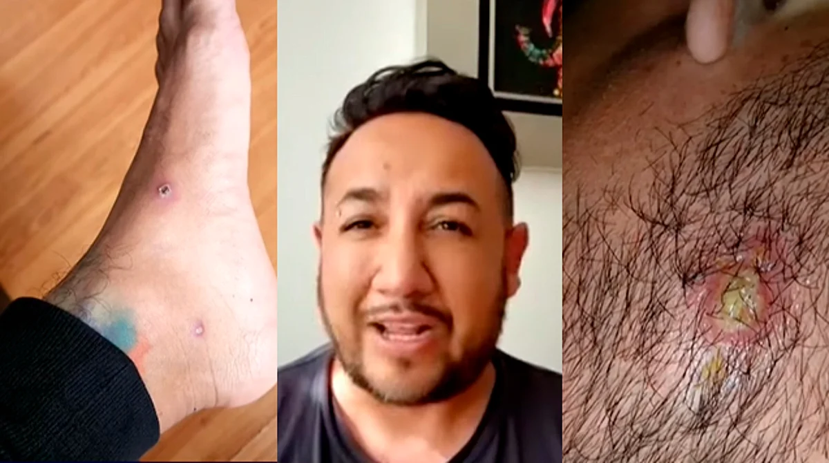 El joven recordó que todo inició el 31 de julio y que lleva ya once días con la enfermedad