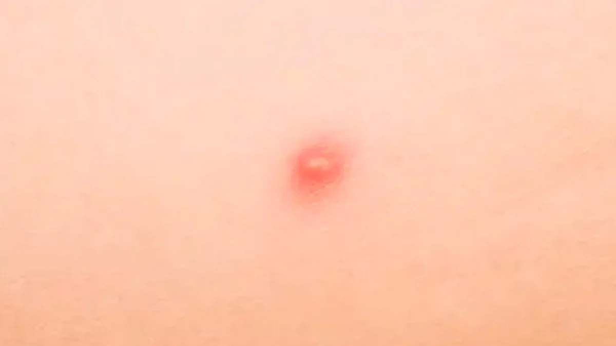 En EU suman tres casos de esta viruela en niños