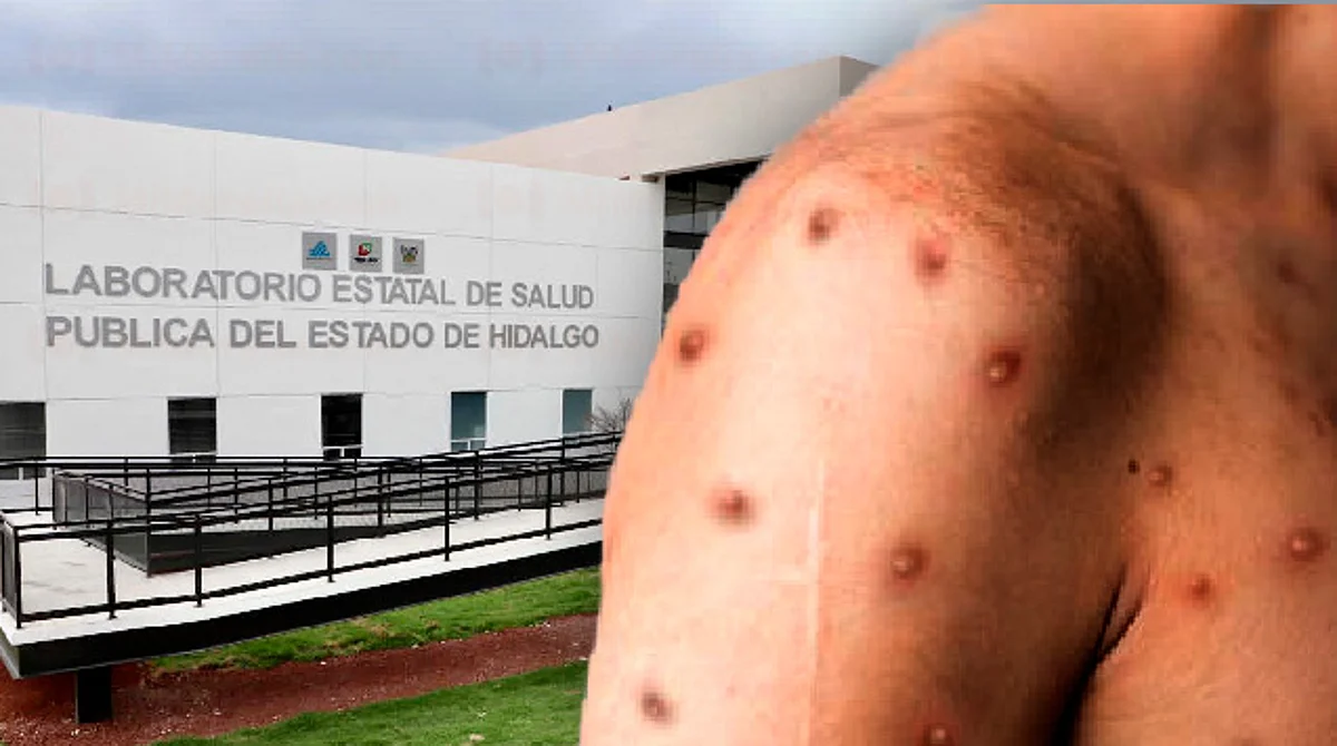 Hidalgo confirma su primer caso de viruela de mono