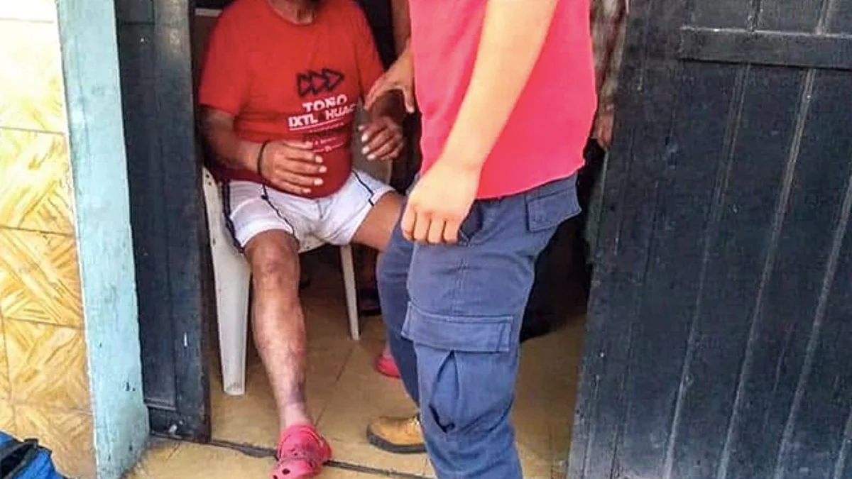 Tras prenderse su bebida con alcohol, hombre michoacano sufre quemaduras