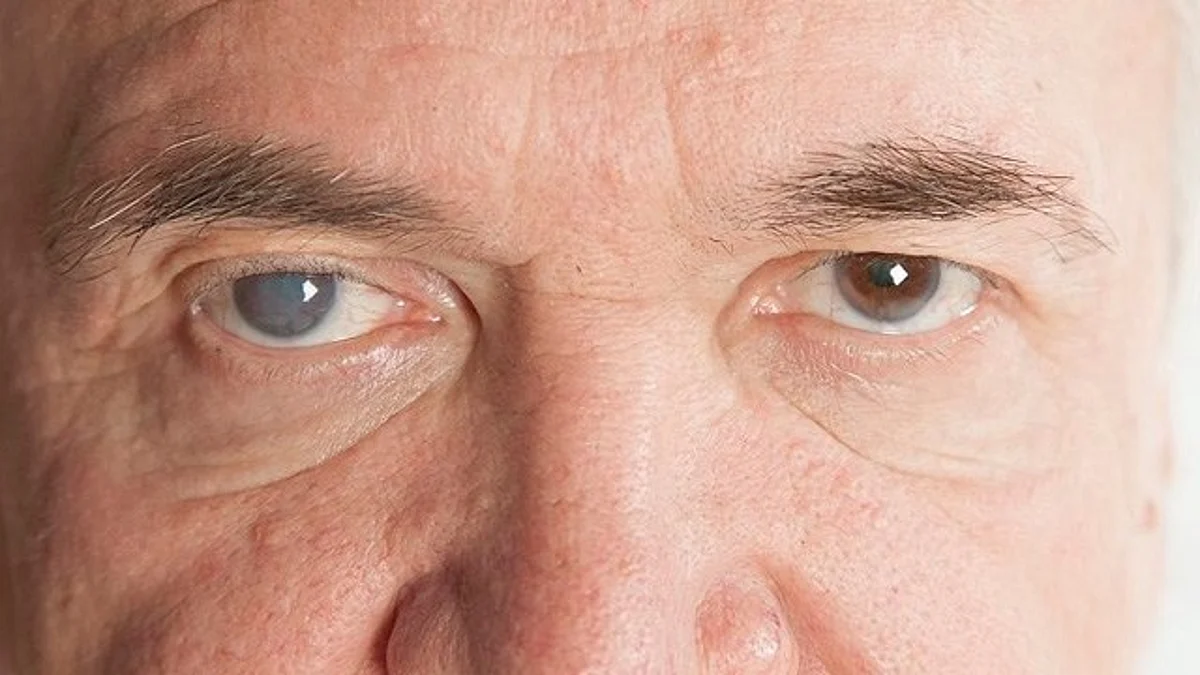 El glaucoma es la primera causa de ceguera irreversible en México