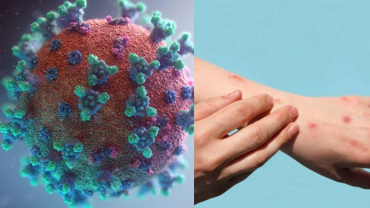 what is difference between monkeypox and coronavirus