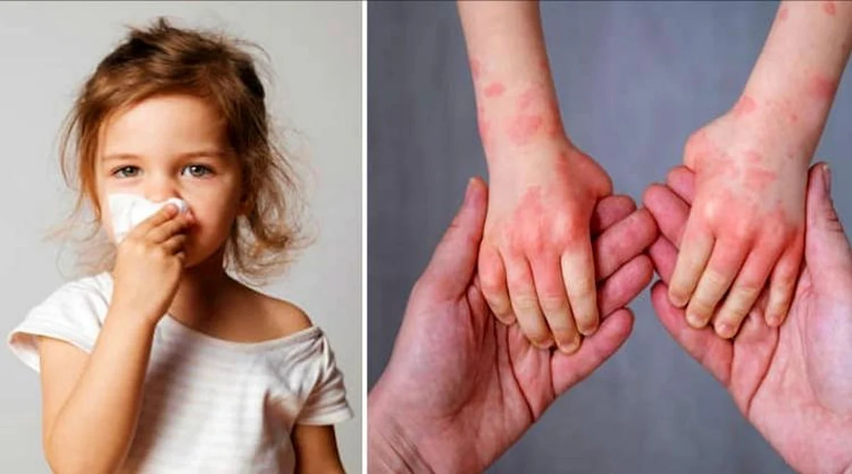 tomato flu symptoms and treatment