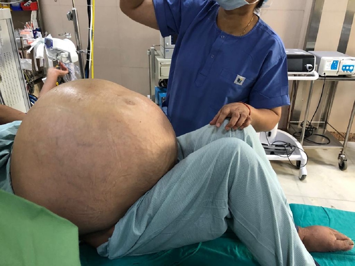 Medical wonder: Doctors in Delhi remove 50 kg ovarian tumour from a woman!