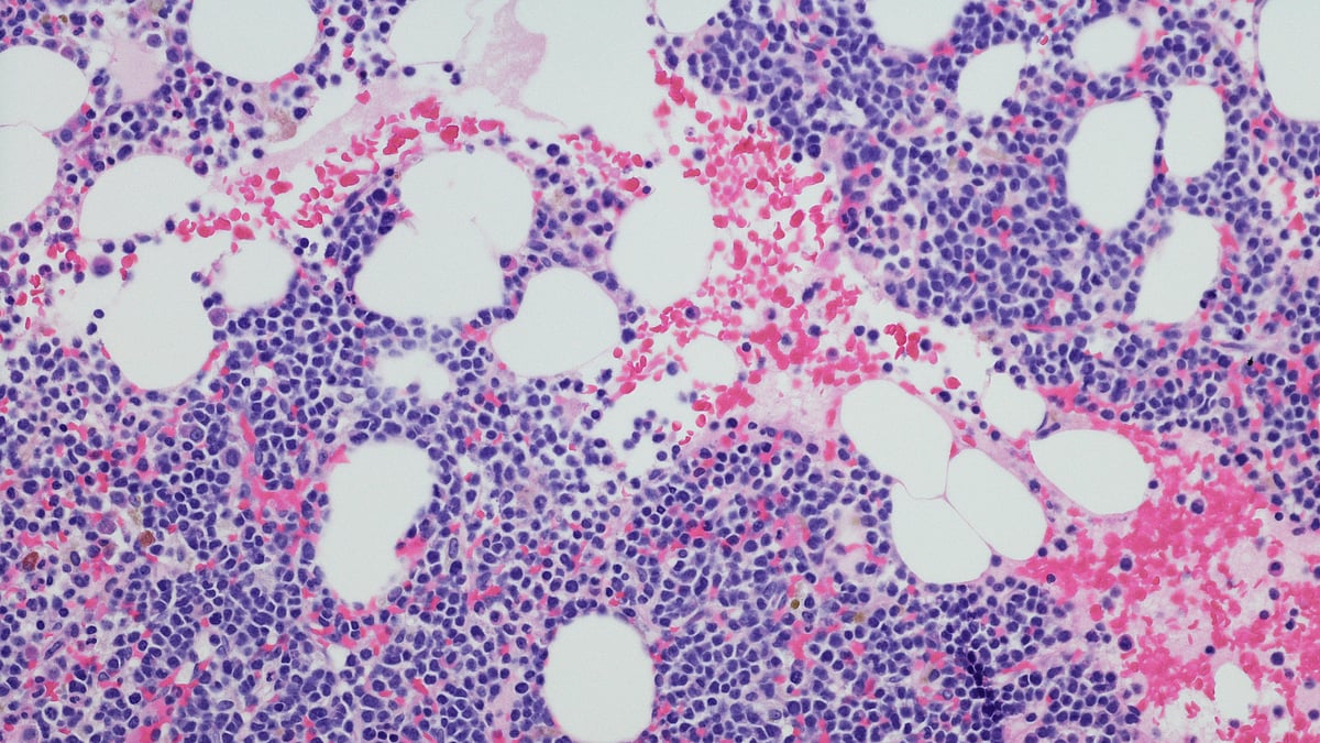 Bone marrow transplant effective for multiple myeloma patients Experts