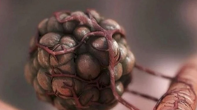 Gallbladder, biliary tract cancer cases up 76% in 3 decades